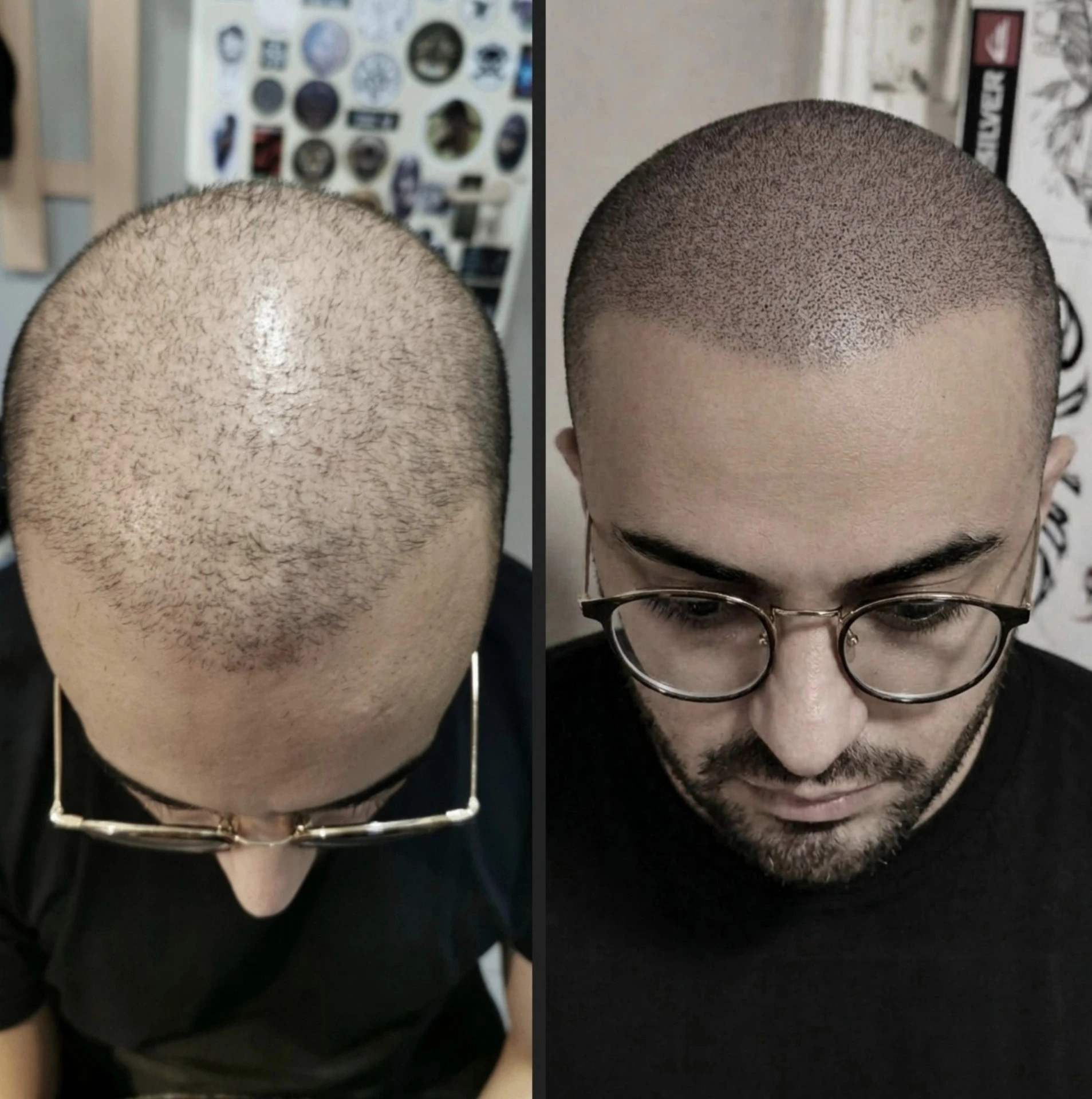 HAARPIGMENTIERUNG vs. HAARTRANSPLANTATION