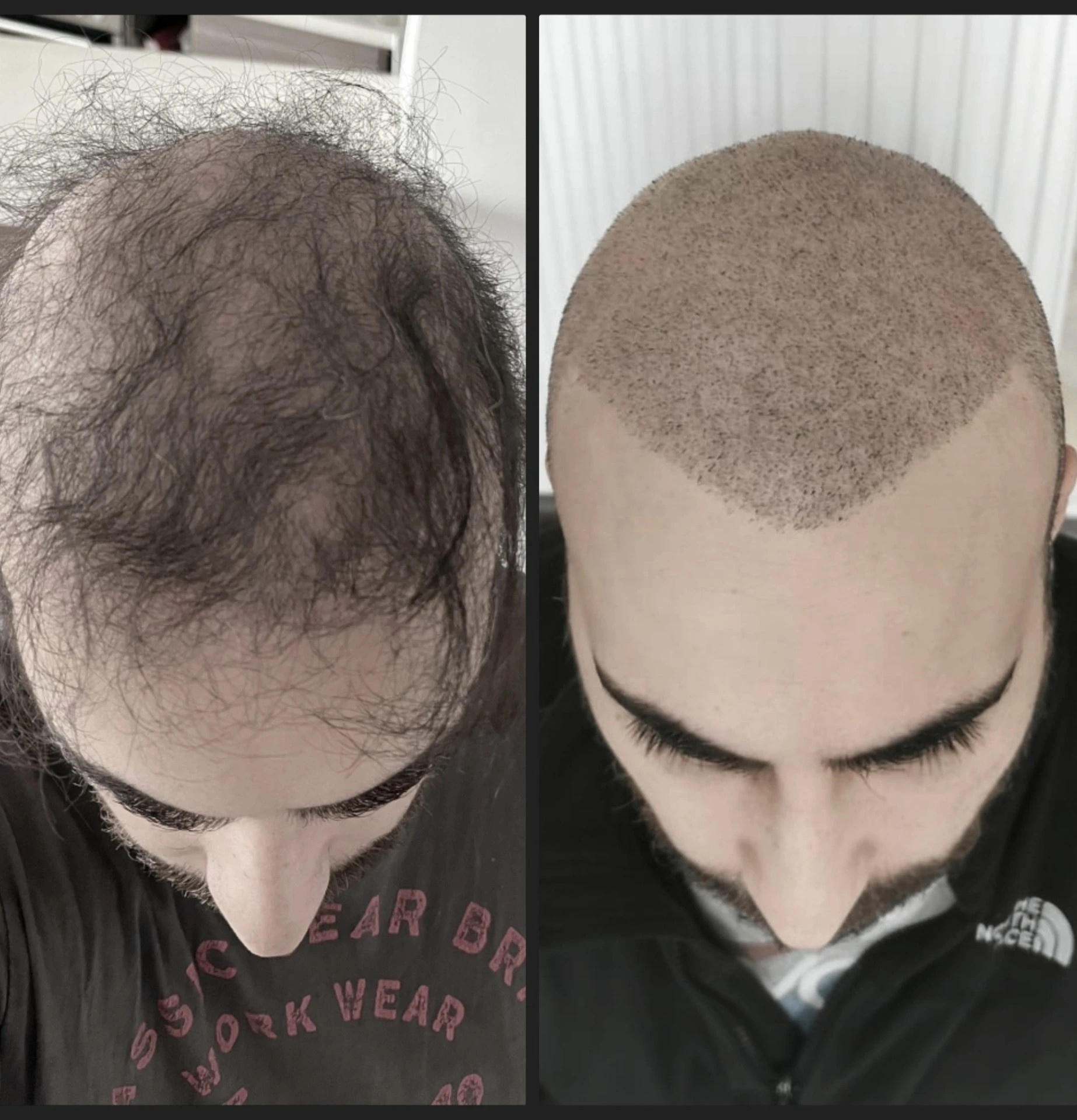 KORREKTUR NACH UNVOLLSTÄNDIGER HAARTRANSPLANTATION