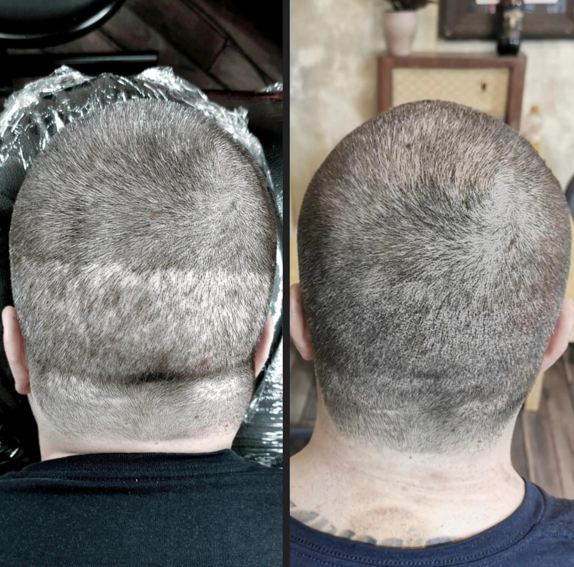 NARBENKORREKTUR NACH HAARTRANSPLANTATION