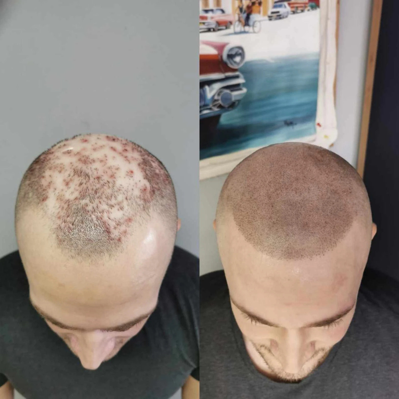 EFFEKTIVE LÖSUNG BEI HAARAUSFALL UND ALOPEZIE